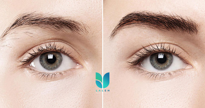 نتیجه کاشت ابرو