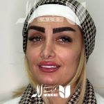 کاشت ابرو در کلینیک لاله
