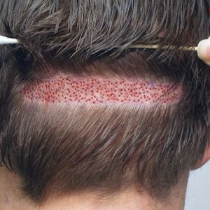 بهترین روش کاشت مو در دنیا