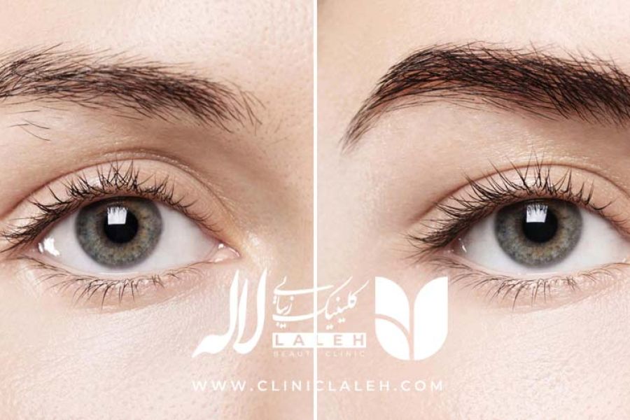 کاشت ابرو یا تتو ابرو، کدام روش را انتخاب کنیم ؟