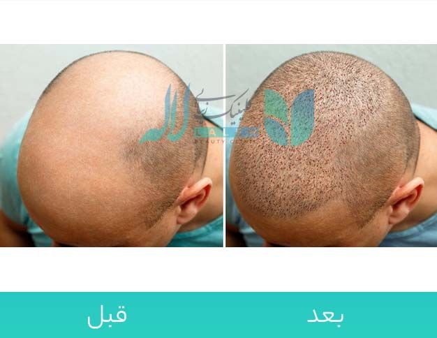  قبل و بعد کاشت مو