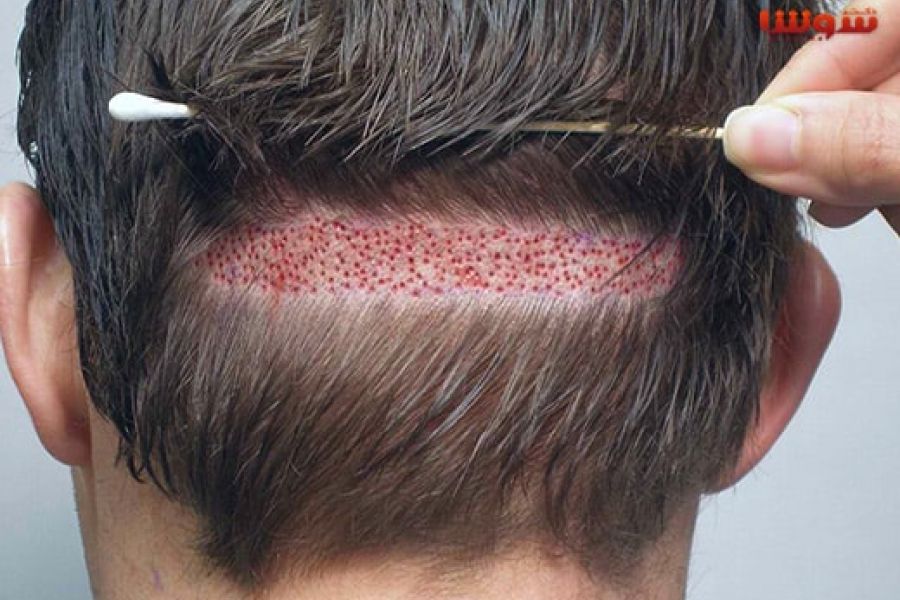 بهترین روش کاشت مو در دنیا