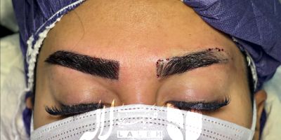 12 نکته مهم بعداز کاشت ابرو