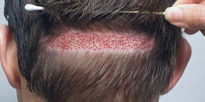 بهترین روش کاشت مو در دنیا