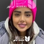 کاشت ابرو در کلینیک لاله