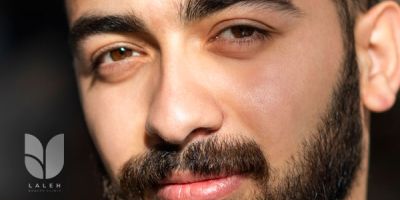 کاشت ریش و سبیل