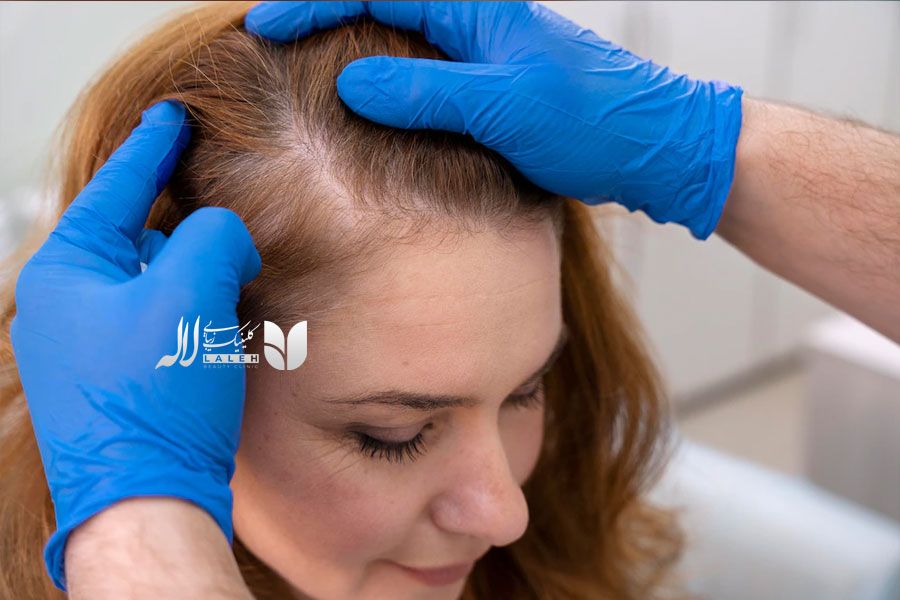 کاشت مو کلینیک لاله