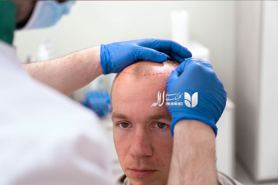 کاشت مو کلینیک لاله