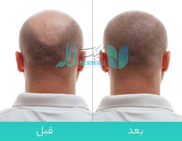  قبل و بعد کاشت مو