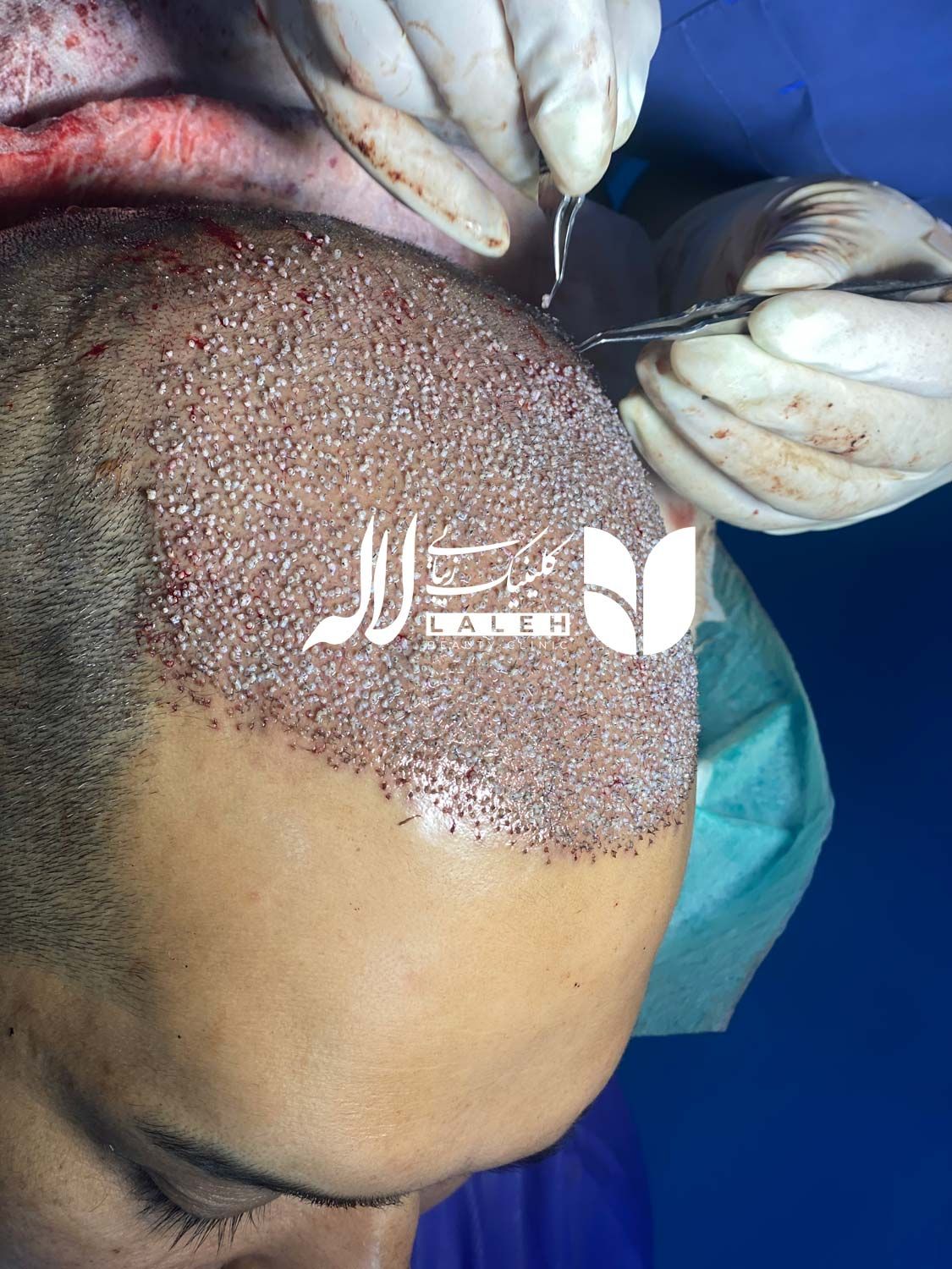 نمونه کاشت مو