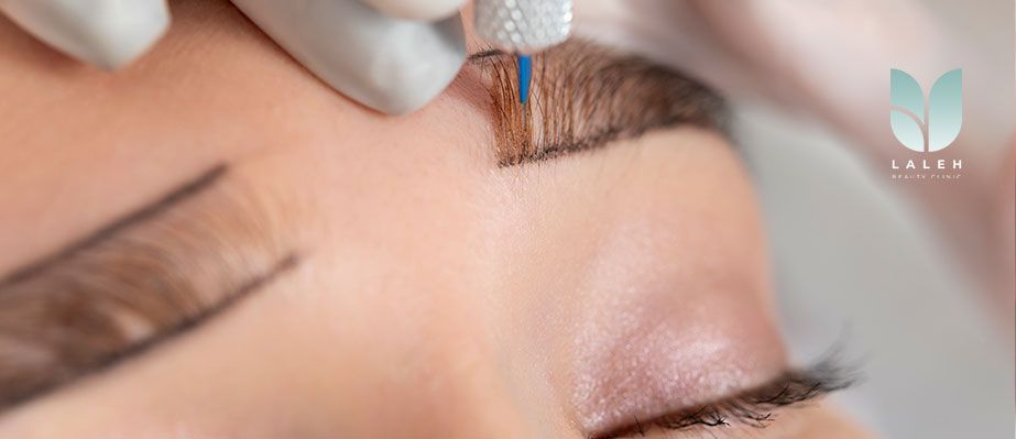 کاشت ابرو