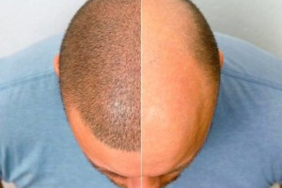 10 کاری که باید پیش از کاشت مو انجام بدهیم