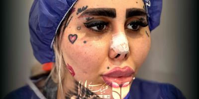 عوارض کاشت ابرو