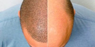 10 کاری که باید پیش از کاشت مو انجام بدهیم