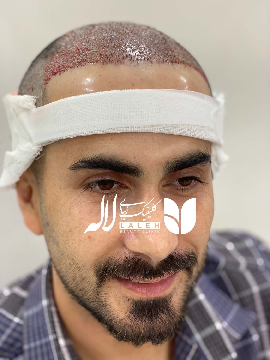 نمونه کاشت مو